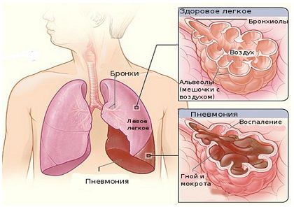 pnevmoniya