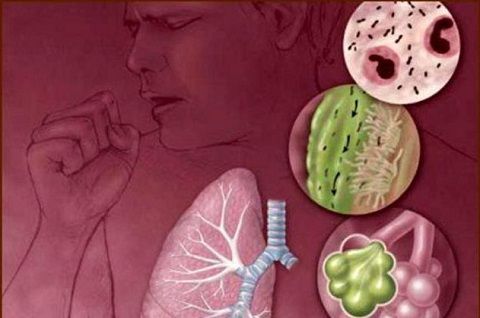 Открытая форма туберкулеза