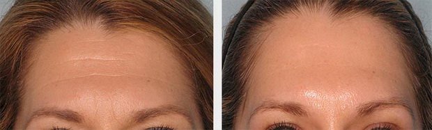 лоб сморщенный и нет