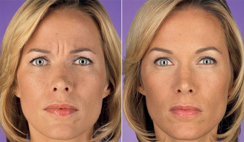 женщина фото до и после Ботокса отзывы