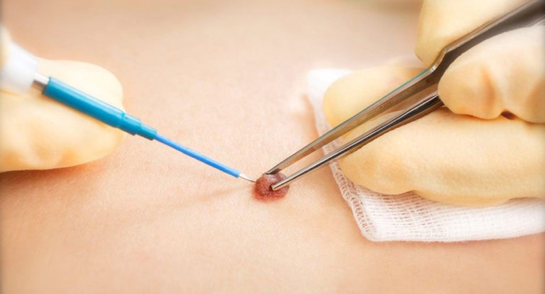 удаление пигментного невуса