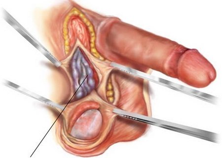 Киста семенного канатика у мальчиков