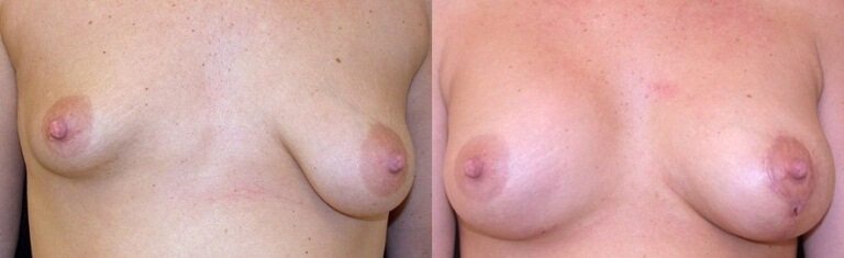 Грудь тубулярная до и после