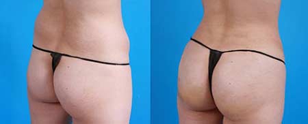 лицо после лазерной биоревитализации