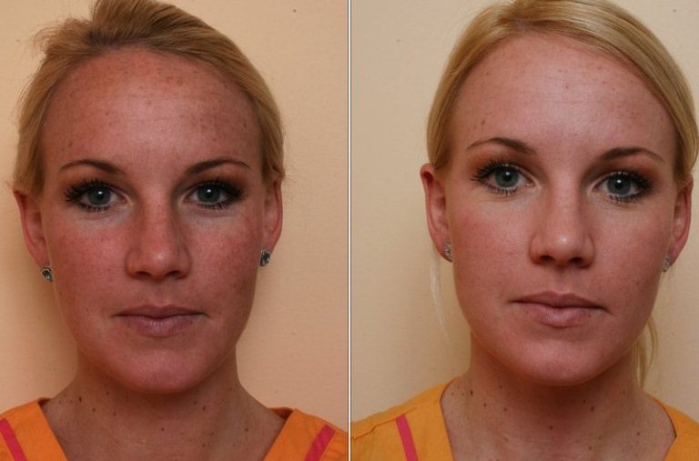 До и после энзимного пилинга