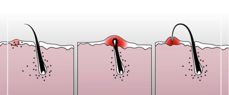 Схема вросших волос