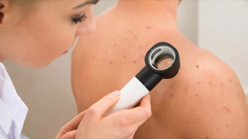 Акне на спине