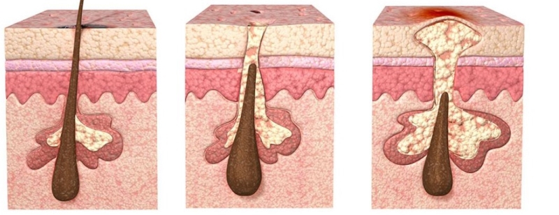 Комедоны на коже