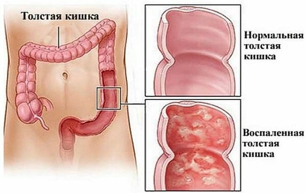 сравнение нормальной и воспаленной толстой кишки