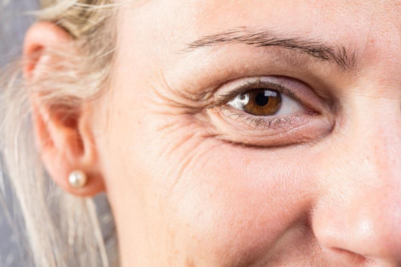 Морщины возле глаз