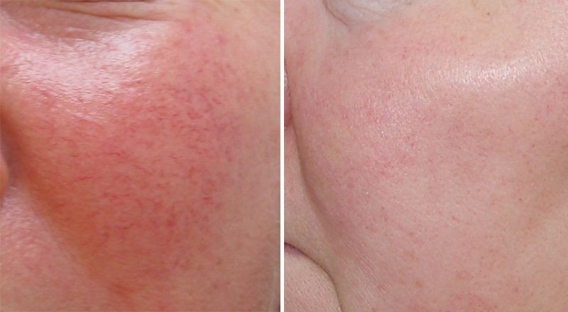 купероз фото до и после лечения в домашних условиях