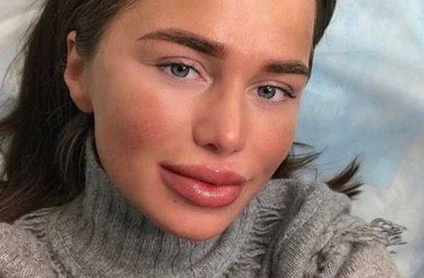 Алекса после пластики