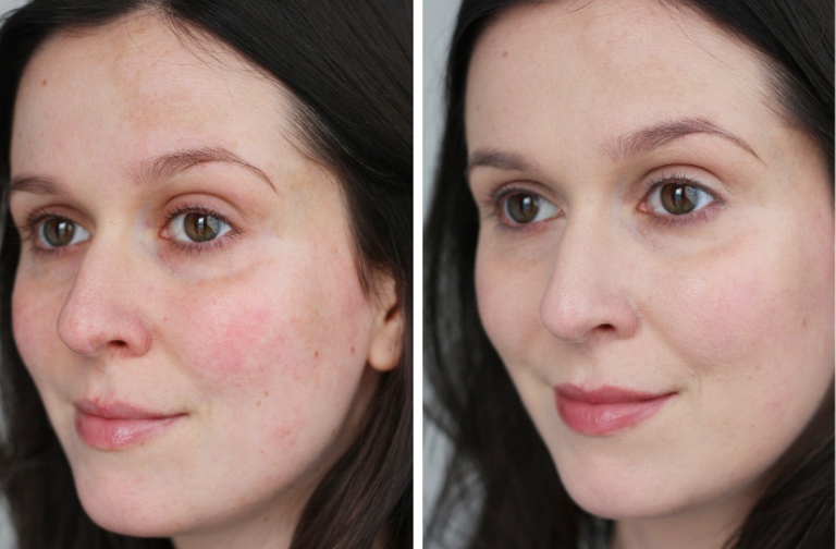 До и после применения мезороллера