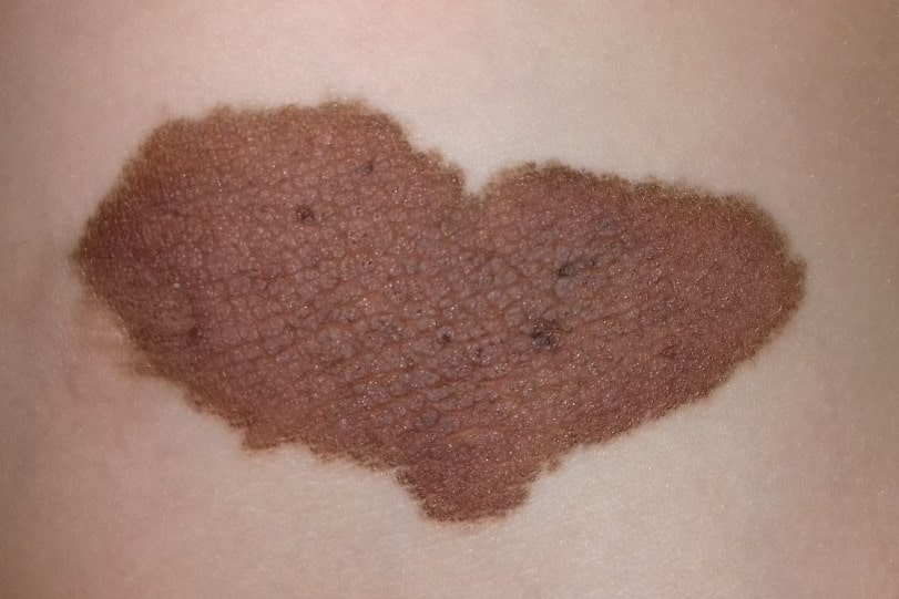 Родимое пятно на коже в виде сердца