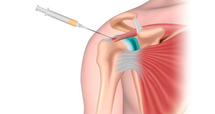 схема процесса плазмолифтинга сустава