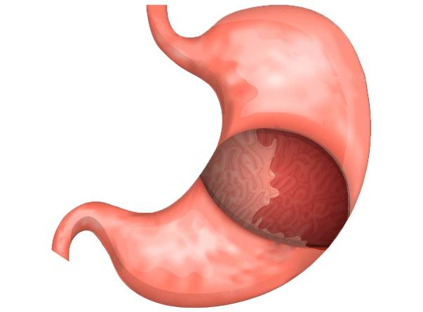 Гастрит Гастрит