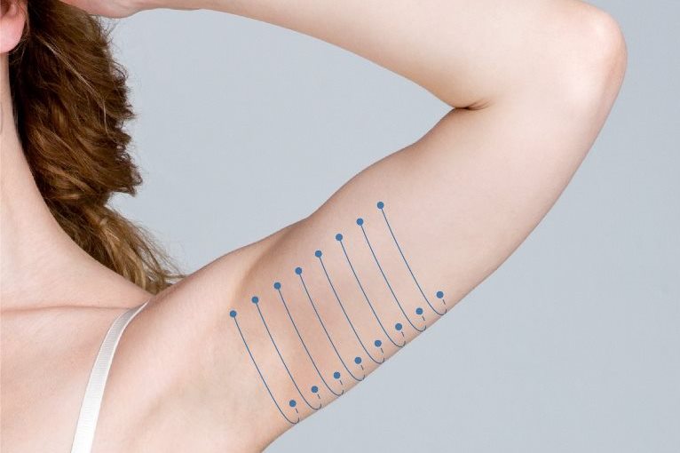 Подтяжка рук нитями