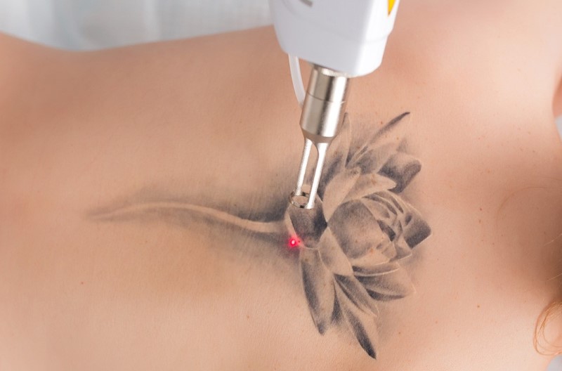 Лазерное удаление тату