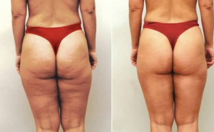 До и после дарсонвализации