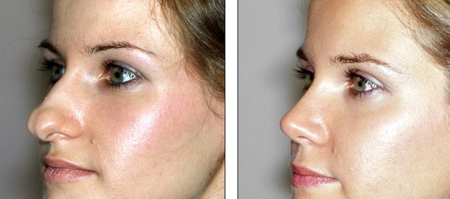 ринопластика фото до и после