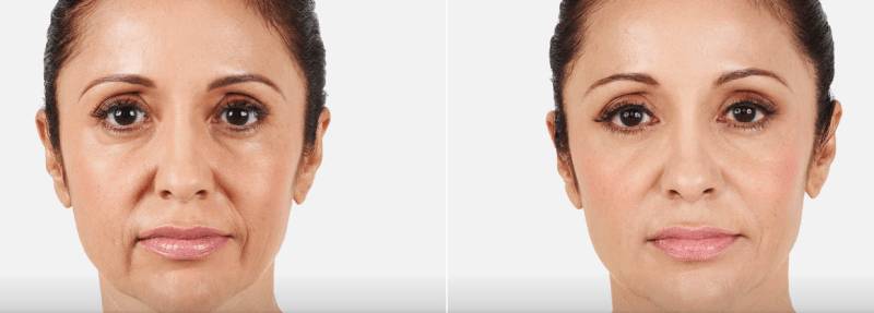 До и после коррекции морщин марионеток