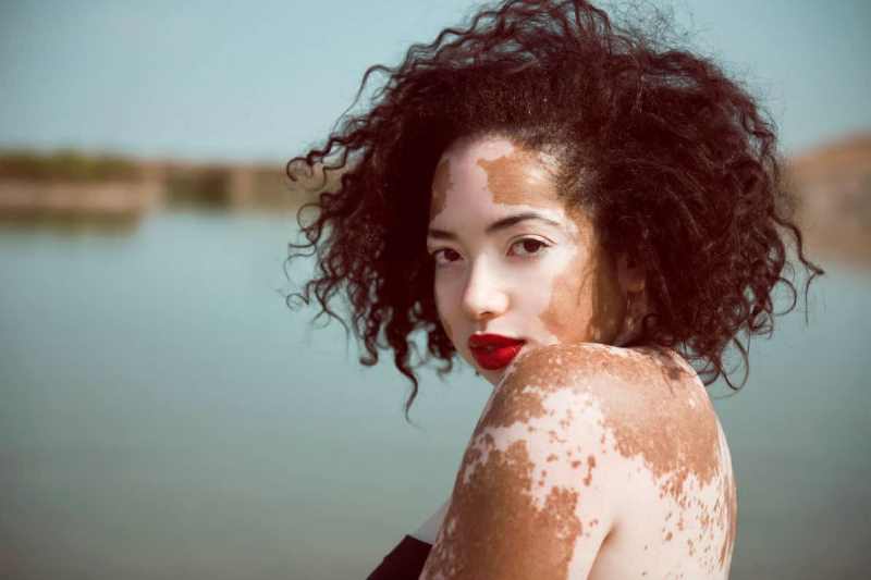 Витилиго на теле