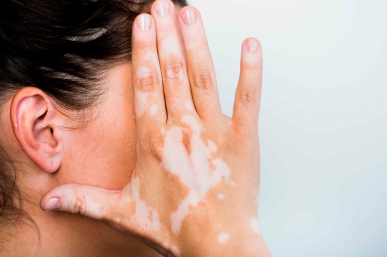 Симптомы витилиго