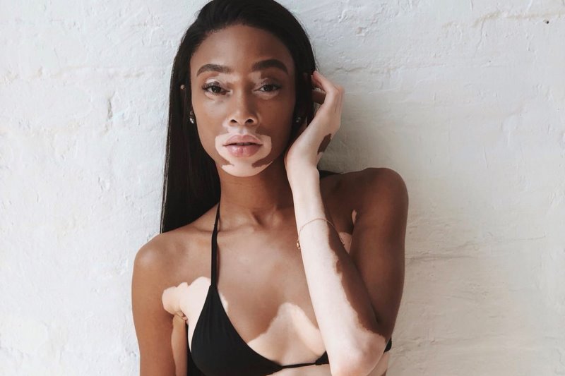 Витилиго симптомы