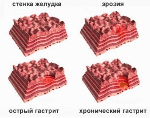 Виды и формы гастрита Виды и формы гастрита