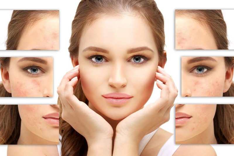 Прыщи на лице