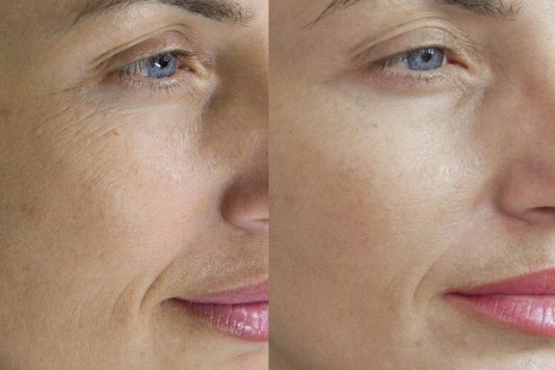 фракционная мезотерапия: до и после