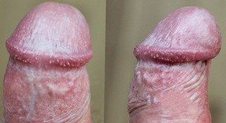 Белый налет на головке у мужчин