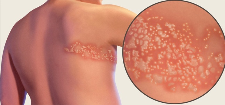 Лишай у человека