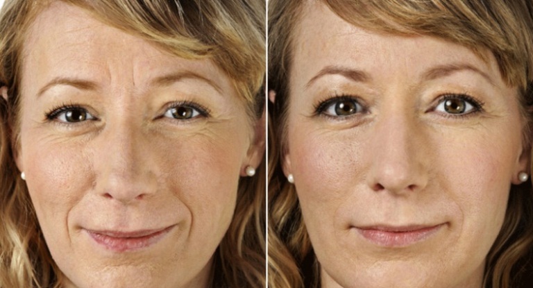 Биоревитализация до и после