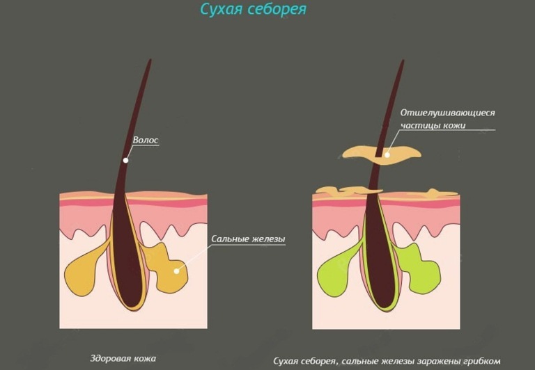 себорея сухая