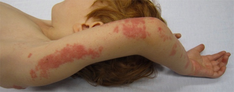 Лишай у ребенка
