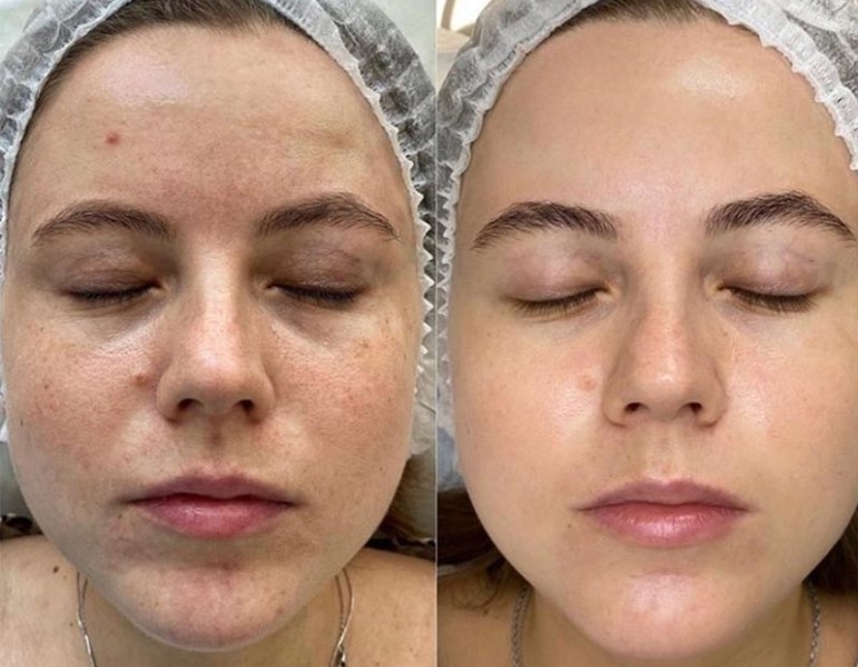 Поверхностный пилинг: фото до и после