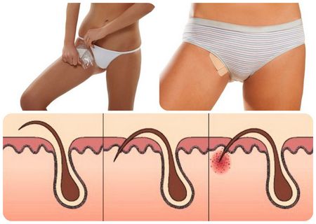 Прыщи на лобке - почему появились, что значиат и как лечить