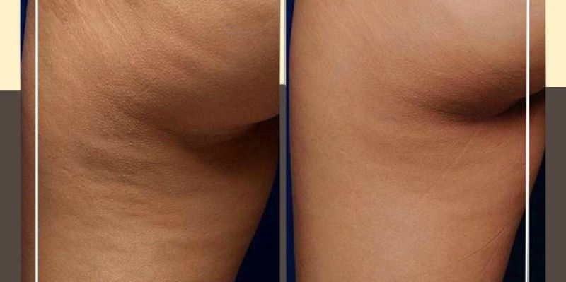 Дермотония: фото до и после