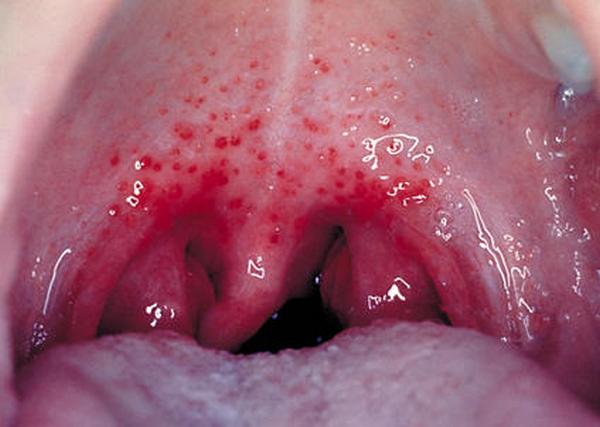 Прыщики в горле - какие могут сигнализировать заболевания