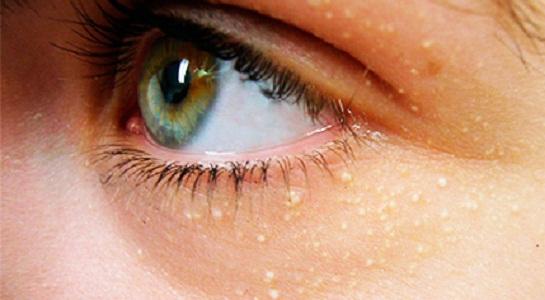 Появилась просянка на веке, как избавиться от проблемы