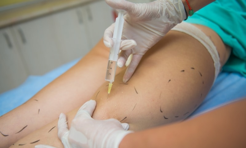 Мезотерапия в области бедер