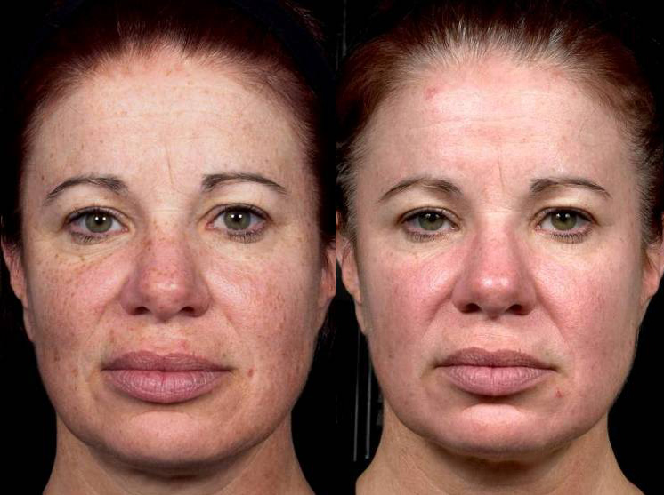 Фототермолиз: фото до и после