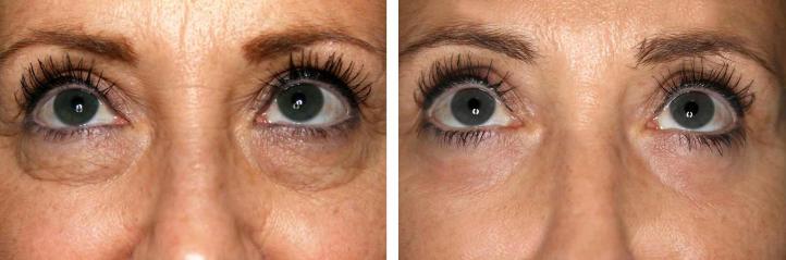 до и после блефаропластики веки женщины