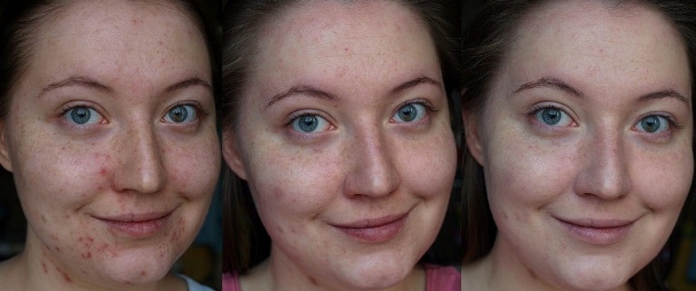 пилинг с фруктовыми кислотами фото до и после