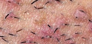 Прыщи на лобке - почему появились, что значиат и как лечить