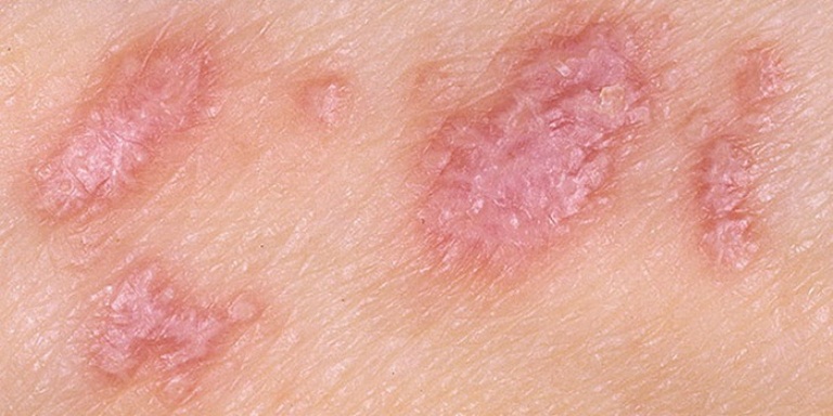 красный лишай у человека симптомы лечение фото