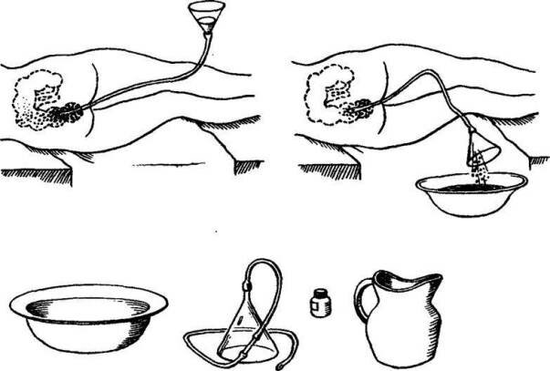 Очистительная клизма Очистительная клизма
