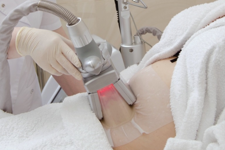 Криолиполиз: что это такое