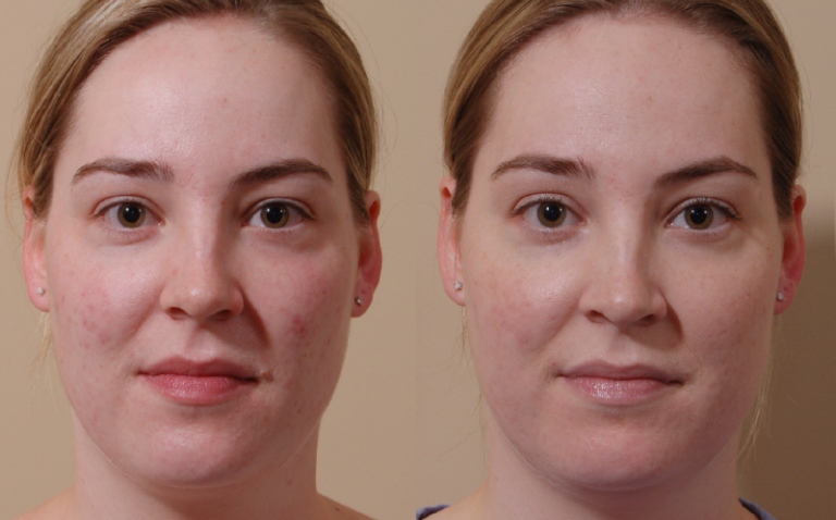 Фото до и после карбонового пилинга